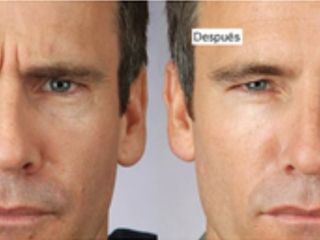 Antes y después de toxina botulínica en hombres