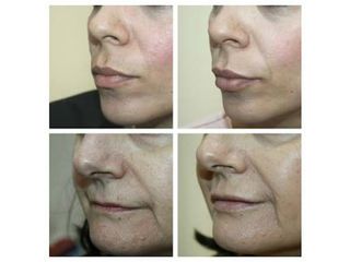 Antes y después de Aumento de labios 