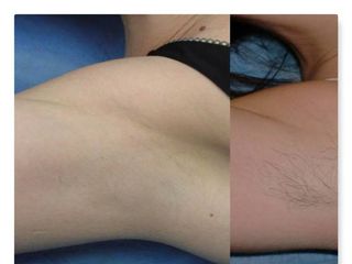 Antes y después de depilación