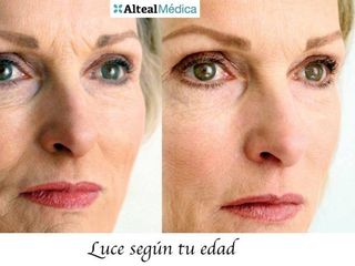 Antes y después de rejuvenecimiento facial