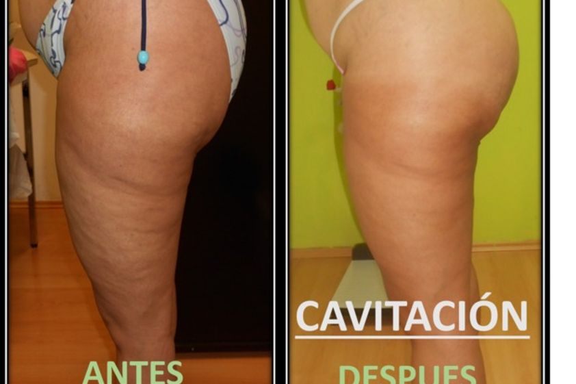 Cavitación antes y después - 605145