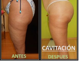 Antes y después de Cavitación