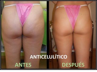 Ante y después de Tratamientos anticelulíticos 