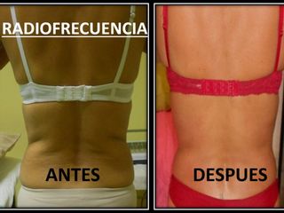 Antes y después de Radiofrecuencia