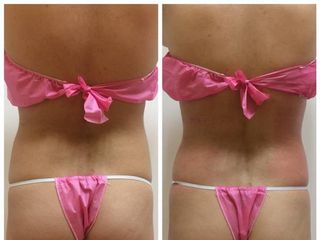 Antes y después de sesión Vacumterapia Laterales