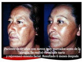 Antes y después de Rinoplastia y rejuvenecimiento facial