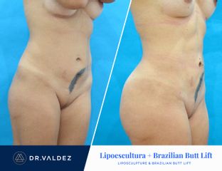 Antes y después de Lipoescultura