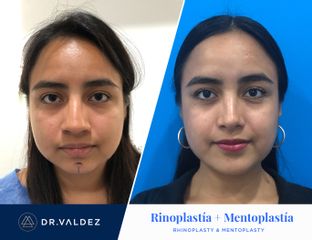 Antes y después de Rinoplastia + Mentoplastia