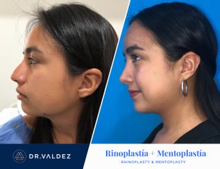Antes y después de Rinoplastia + Mentoplastia