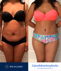 Antes y después de Abdominoplastia