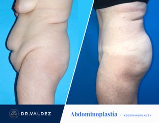 Antes y después de Abdominoplastia