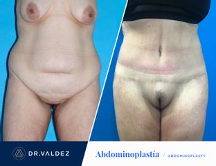Antes y después de Abdominoplastia