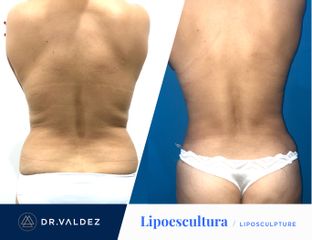 Antes y después de Lipoescultura