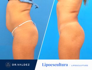 Antes y después de Lipoescultura