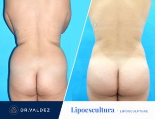 Antes y después de Lipoescultura