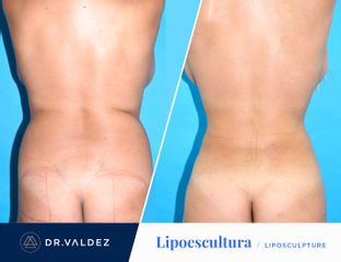 Antes y después de Lipoescultura