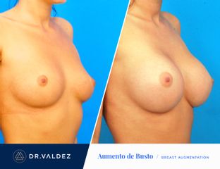 Antes y después de Aumento de busto