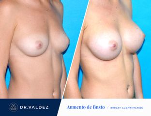 Antes y después de Aumento de busto