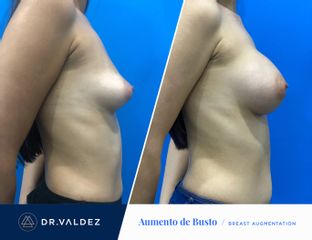 Antes y después de Aumento de busto