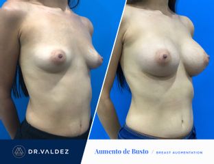 Antes y después de Aumento de busto