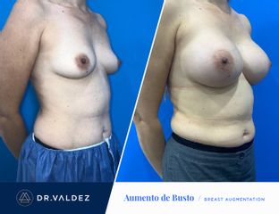Antes y después de Aumento de busto