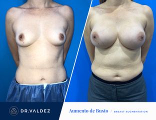 Antes y después de Aumento de busto