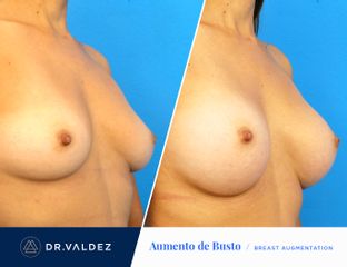 Antes y después de Aumento de busto