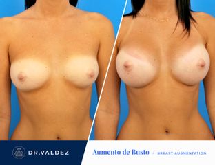 Antes y después de Aumento de busto