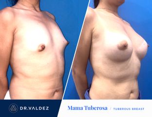 Antes y después de Aumento de busto