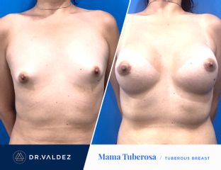 Antes y después de Aumento de busto