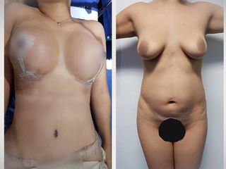 Antes y después de Mommy makeover