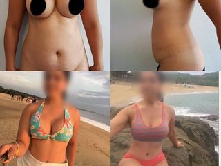 Antes y después de Mommy makeover