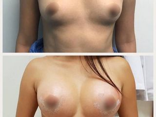 Antes y después de Aumento de busto