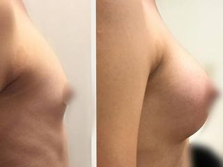 Antes y después de Aumento de busto