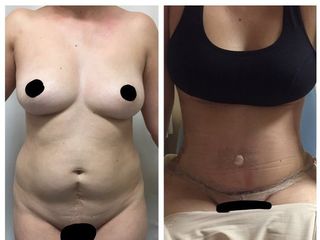 Antes y después de Mommy makeover