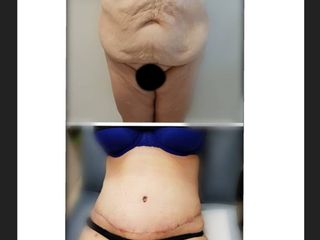 Antes y después de Abdominoplastía post pérdida masiva de peso