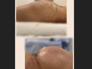 Antes y después de Aumento de Glúteos con Grasa