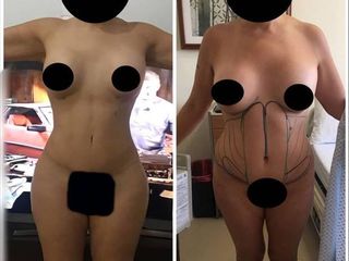 Antes y después de Lipo HD 