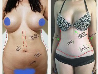 Antes y después de Mommy makeover