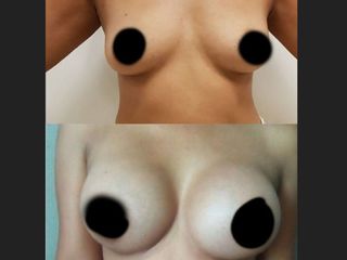 Antes y después de Aumento de Busto
