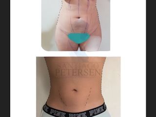 Antes y después de Lipoescultura