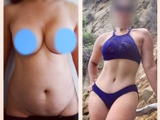 Antes y después de Mommy Makeover