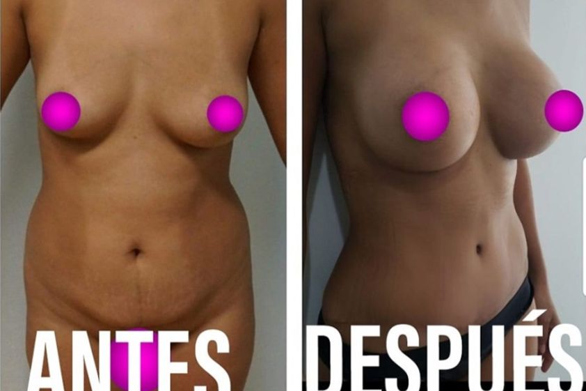 Mommy makeover antes y después - 642192