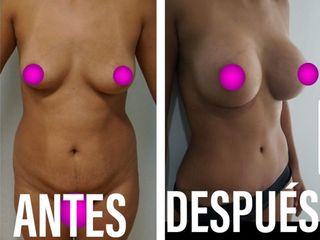 Antes y después de Mommy Makeover 