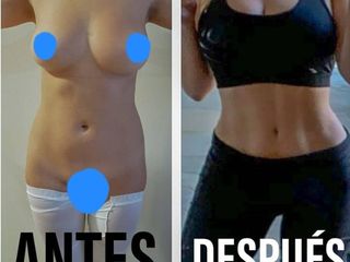 Antes y después de Liposucción BBL glúteos HD 