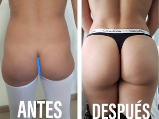 Antes y después de Gluteoplastia