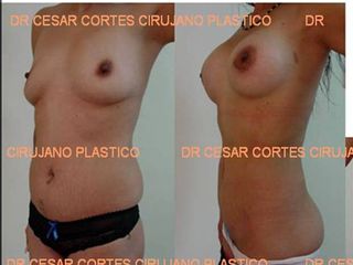 Antes y después de aumento de busto y Lipoescultura