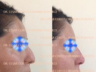 Antes y después de Rinomodelación, manejo de nariz con y sin cirugía