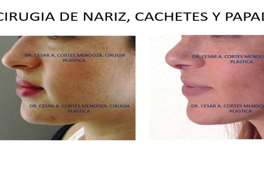 Bolsas de Bichat antes y después - 633391