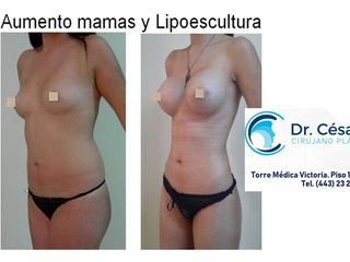 Antes y después de aumento y lipoescultura